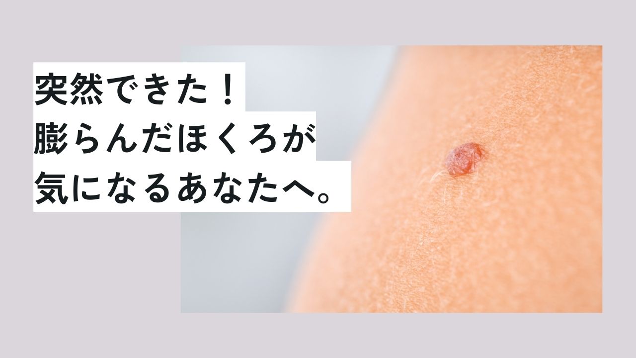 突然できた！膨らんだほくろが気になるあなたへ。